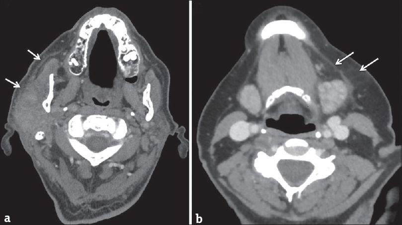 Bacterial sialadenitis. (a) Axial computed tomography in a 70-year-old male with acute right parotid swelling and purulent drainage. (b) Axial computed tomography in a 69-year-old female with acute left submandibular swelling. Both cases demonstrate asymmetric enlargement of a salivary gland with thickening of the adjacent platysma muscle and stranding in the subcutaneous fat (white arrows). Both cases resolved clinically after antibiotics.