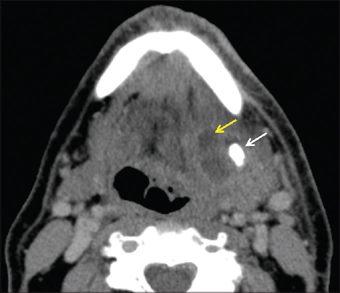 Salivary gland abscess. A 69-year-old male presents with left submandibular swelling and purulent drainage. Axial computed tomography demonstrates asymmetric enlargement of the left submandibular gland with thickening of the adjacent platysma and fat stranding. A large 1.2 cm sialolith (white arrow) and 2 cm abscess (yellow arrow) are also present. The patient ultimately required surgical excision of the submandibular gland and abscess drainage.