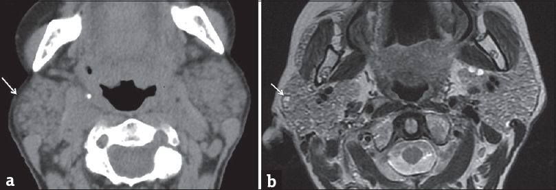 Early Sjogren's syndrome. Axial computed tomography (a) and axial T2-weighted magnetic resonance image (b) demonstrate enlarged parotid glands with areas of cystic changes (white arrows).