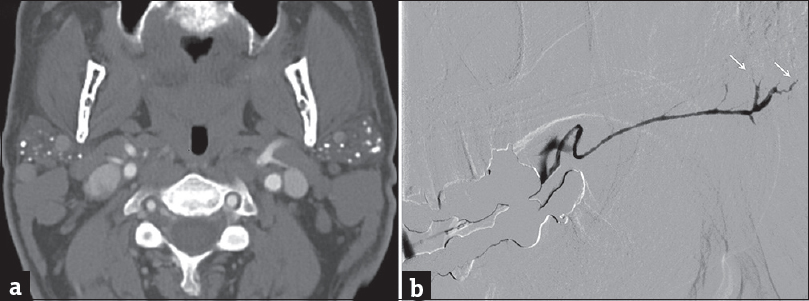 Chronic Sjogren's syndrome. (a) Axial computed tomography demonstrates atrophic parotid glands with multiple parenchymal calcifications. (b) Sialogram of the left submandibular duct demonstrates multifocal areas of narrowing/irregularity through the main duct with pruning of the intraglandular ducts (white arrows).