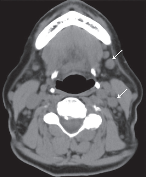 Sjogren's syndrome with lymphoma. A 76-year-old female with a history of Sjogren's syndrome with bilateral palpable cervical lymph nodes. Axial computed tomography demonstrates multiple mildly enlarged level Ib and IIb lymph nodes (white arrows). Biopsy proved non-Hodgkin lymphoma.