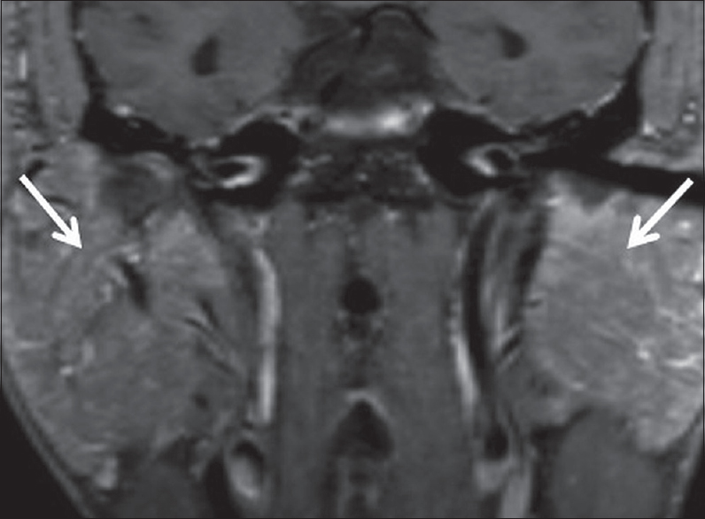 Sarcoid sialadenitis. A 51-year-old male with a history of pulmonary sarcoidosis presents with bilateral parotid swelling. Coronal T1 FS + C images demonstrate marked enlargement and hyperenhancement of the bilateral parotid glands (white arrows), presumably reflecting sarcoid sialadenitis.