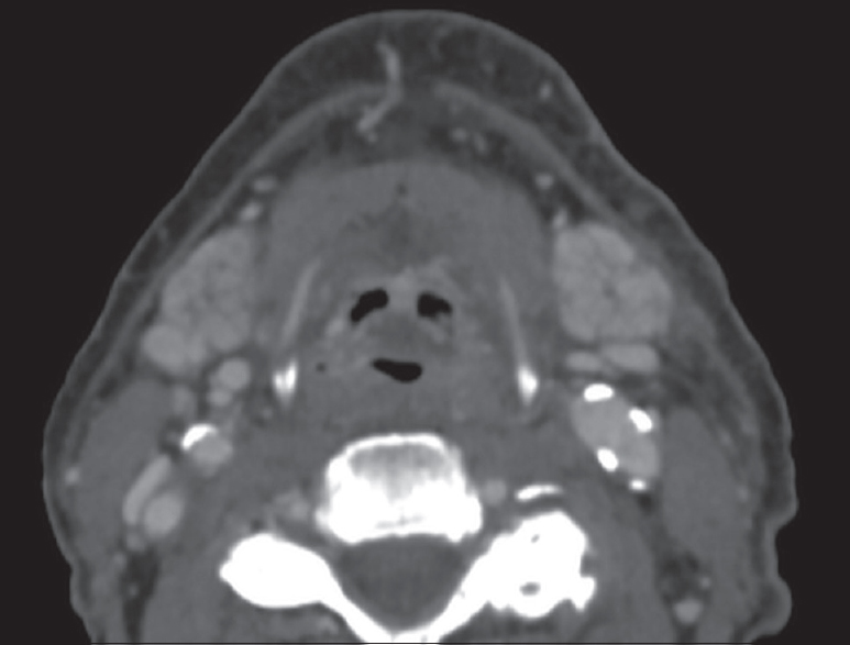 Radiation-induced sialadenitis. Axial computed tomography demonstrates hyperenhancement of the bilateral submandibular glands in a patient recently treated with external beam radiation for oropharyngeal cancer.