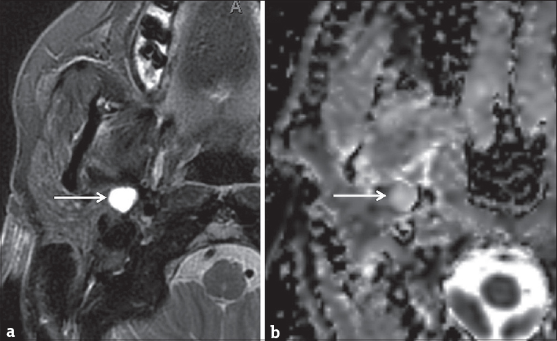 Pleomorphic adenoma. Axial T2-weighted (a) and axial apparent diffusion coefficient (b) Magnetic resonance images demonstrate a well-circumscribed high signal lesion in the deep portion of the right parotid gland (white arrows). Note that the lesion demonstrates T2 hyperintensity greater than nearby cerebrospinal fluid.