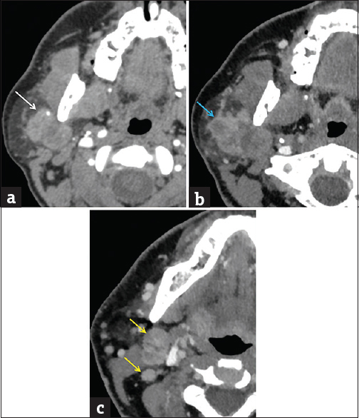 Carcinoma ex pleomorphic adenoma. (a) Axial computed tomography image demonstrates a well-circumscribed mass spanning the superficial and deep portions of the right parotid gland (red arrow), nonspecific in etiology. (b) Axial computed tomography image performed 4 months later demonstrates rapid enlargement with infiltrative margins (blue arrow). (c) Axial computed tomography image at a slightly lower level demonstrates new right level II lymph nodes (yellow arrows). Pathologically confirmed carcinoma ex pleomorphic adenoma with metastatic lymphadenopathy.