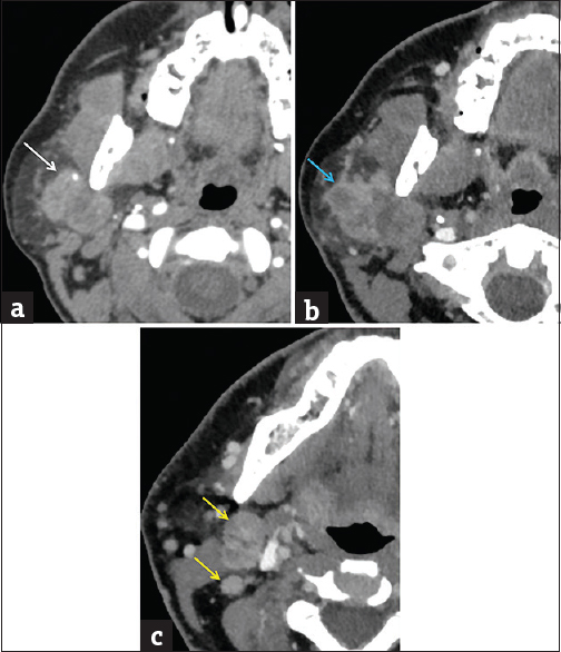 Review Of The Major And Minor Salivary Glands Part 2 Neoplasms And Tumor Like Lesions Journal Of Clinical Imaging Science