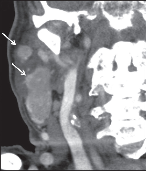 Warthin's Tumor. A 94-year-old male with right neck swelling. Coronal contrast-enhanced computed tomography images demonstrate multifocal enhancing masses in the right parotid gland (white arrows), pathologically proven Warthin's Tumor.