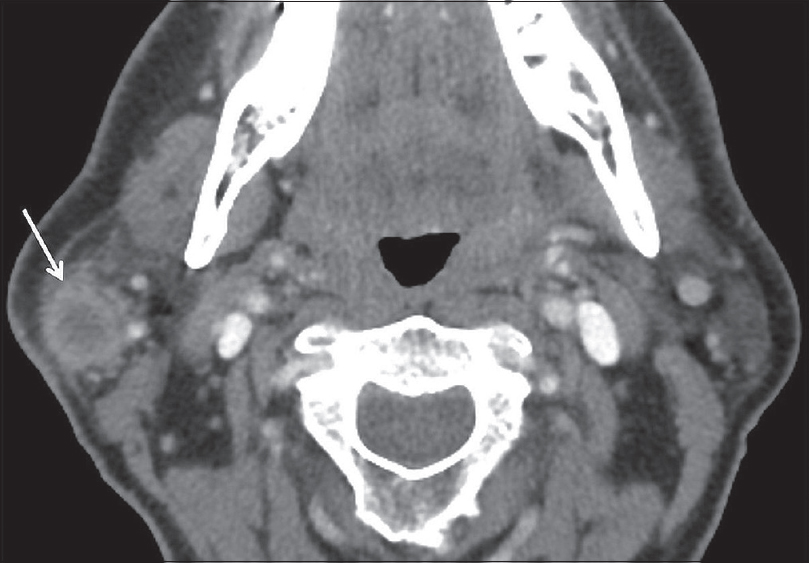 Mucoepidermoid Carcinoma. A 53-year-old male with right neck pain and palpable lump. Axial contrast-enhanced computed tomography image demonstrates an enhancing mass with ill-defined margins and central cystic component (white arrow).