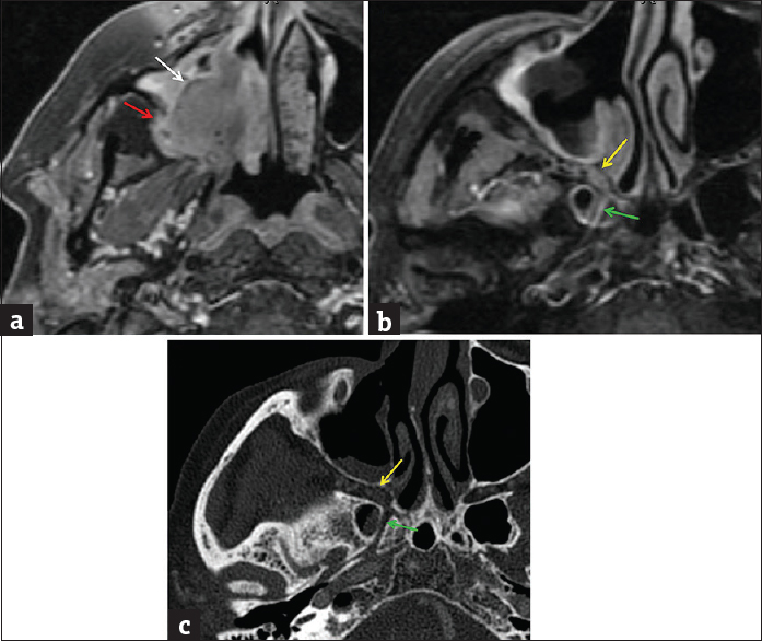 Adenoid cystic carcinoma, sinonasal minor salivary gland origin. (a) Axial T1-weighted postcontrast fat-suppressed magnetic resonance image demonstrates a heterogeneous mass in the right maxillary sinus (white arrow). Posteriorly, there is osseous invasion through the wall of the maxillary sinus into the retroantral fat (red arrow). Axial T1-weighted postcontrast fat-suppressed magnetic resonance image (b) and axial computed tomography image (c) demonstrate asymmetric widening and enhancement in the pterygopalatine fossa (yellow arrow) and vidian canal (green arrow), consistent with perineural spread of tumor.