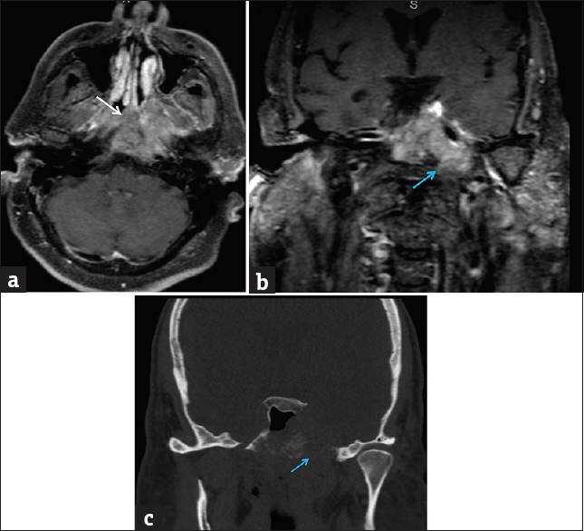 Adenoid cystic carcinoma, nasopharynx minor salivary gland origin. (a) Axial T1-weighted postcontrast fat-suppressed magnetic resonance image demonstrates a large heterogeneous mass centered in the nasopharynx (white arrow). Coronal T1-weighted postcontrast fat-suppressed magnetic resonance image (b) and coronal computed tomography image (c) demonstrate associated destruction of the central skull base with perineural extension through left foramen ovale (blue arrows).