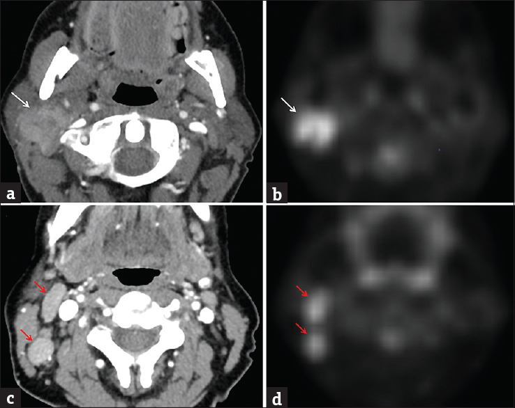 Acinic cell carcinoma. A 51-year-old female with enlarging palpable right parotid mass over 3 months. Axial contrast-enhanced computed tomography (a) and transverse FDG-PET (b) images demonstrate a hypermetabolic ill-defined mass within the lower right parotid gland, extending toward the tail (white arrows). At a slightly lower level, axial contrast-enhanced computed tomography (c) and transverse FDG-PET (d) images demonstrate enlarged hypermetabolic right level II lymph nodes (red arrows). Pathologically proven acinic cell carcinoma with metastatic lymphadenopathy.