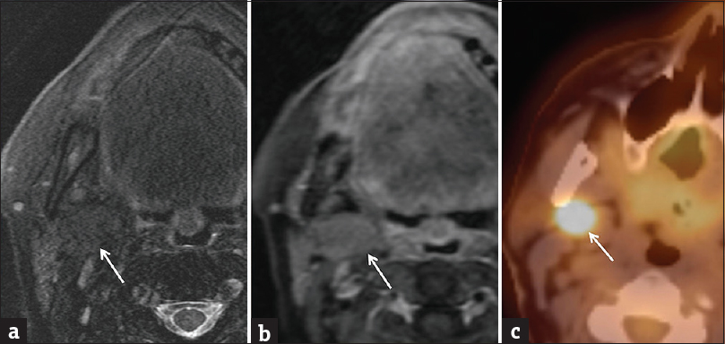 Oncocytoma. (a) Axial T2-weighted fat-suppressed image demonstrates a barely perceptible mass in the deep portion of the parotid gland (white arrow), isointense to normal parotid parenchyma. (b) Axial T1-weighted postcontrast fat-suppressed image also demonstrates a subtle mass isointense to normal parotid parenchyma (white arrow). (c) Transverse fused PET/computed tomography image demonstrates an obvious hypermetabolic mass (white arrow). Pathologically proven oncocytoma.