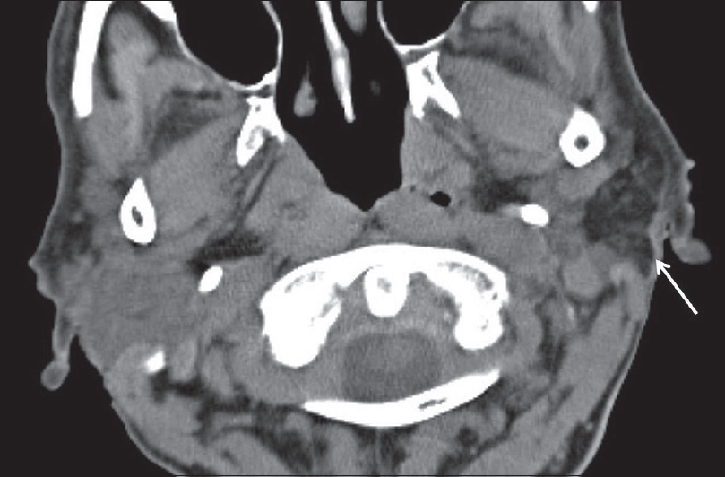 Lipoma. An 81-year-old female presents with dysarthria and aphasia. Axial computed tomography image demonstrates an incidental mass in the left parotid gland with attenuation characteristics equal to fat (white arrow). Findings compatible with a parotid gland lipoma.