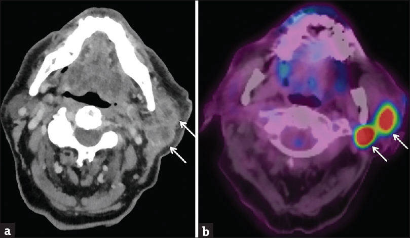 Intraparotid Metastases. A 90-year-old male with a history of left temple cutaneous squamous cell carcinoma presents with the left cheek swelling. Axial computed tomography (a) and fused PET/computed tomography (b) images demonstrate two hypermetabolic necrotic lymph nodes in the left parotid tail (white arrows). Biopsy-proven metastatic squamous cell carcinoma.