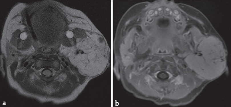 Hemangioma. A 1-month-old infant with left neck mass. Axial T2-weighted image (a) and axial T1-weighted postcontrast fat-suppressed (b) images demonstrate a lobulated mass in the left parotid gland with T2 hyperintensity and homogeneous enhancement, compatible with an infantile hemangioma.