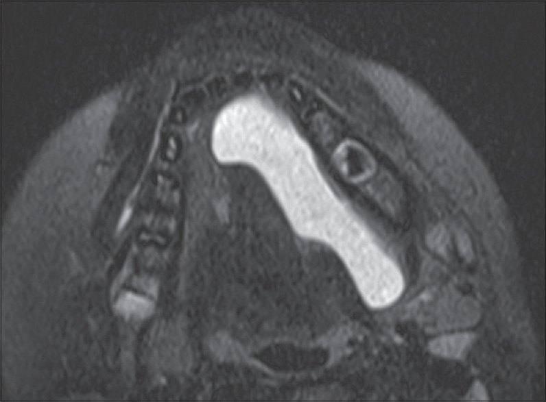 Simple ranula. A 7-year-old male with swelling along the left floor of mouth. Axial T2 fat-suppressed image demonstrates a cystic lesion occupying the entire left sublingual space. Note there is no extension beyond the mylohyoid sling into the submandibular space.