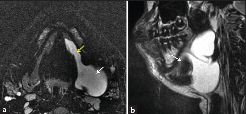 Plunging ranula. A 15-year-old male with swelling along the left floor of the mouth. Axial (a) and sagittal (b) T2-weighted fat-suppressed images demonstrate a cystic lesion occupying the entire sublingual space with extension beyond the posterior margin of the mylohyoid sling (white arrow) into the submandibular space. Note narrower “tail” (yellow arrow) in the portion left behind in the sublingual space.