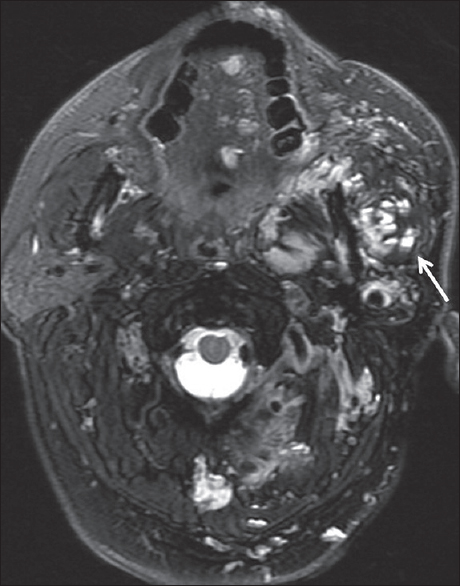 Vascular malformation. A 49-year-old male with a history of “vascular lesion since birth,” although no prior imaging was available. Axial T2-weighted fat-suppressed image demonstrates a transspatial lesion involving the left parotid space, masticator space, oral tongue, and paraspinal soft tissues. Hemorrhage-fluid levels are present within many portions of the lesion (white arrow), compatible with a lymphatic malformation.