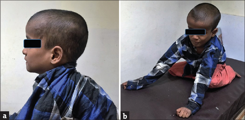 Clinical images of an 8-year old boy with glutaric aciduria type 1 showing (a) macrocrania, (b) hypotonia and inability of the child to sit without support.