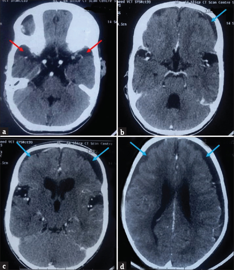 Prior contrast-enhanced computed tomography brain of the patient with glutaric aciduria type 1, performed at 15 months of age, showing mildly increased cerebrospinal fluid spaces anterior to the temporal lobes (red arrows), prominent sylvian fissures, bilateral subdural collections (blue arrows), and dilated ventricular system. No enhancing basal exudates are noted.