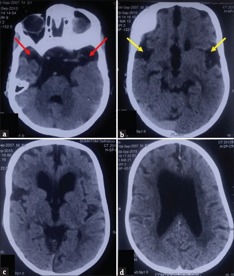 Prior noncontrast computed tomography (a-d) of the patient with glutaric aciduria type 1, obtained at 7 years of age, showing periventricular white matter hypodensities and cerebral atrophy with predominant involvement of temporal lobes, seen as increased cerebrospinal fluid space anterior to temporal lobes (red arrows) and lack of operculation bilaterally leading to bat wing configuration of sylvian fissures (yellow arrows).