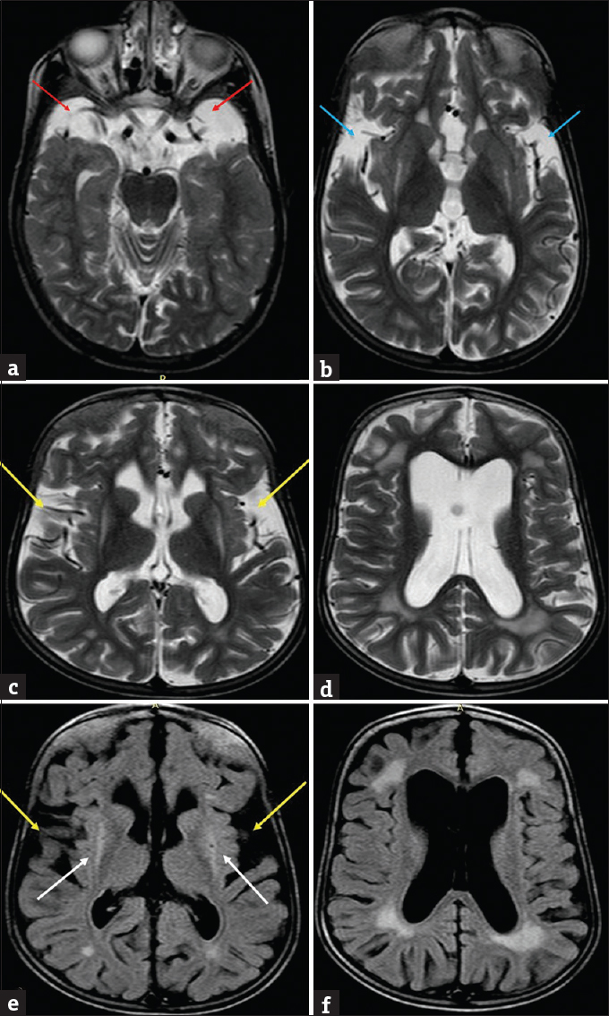 Present magnetic resonance imaging images of the patient with glutaric aciduria at 8 years. T2-weighted images (a) shows widened cerebrospinal fluid spaces anterior to the temporal lobes (red arrows) with temporal lobe hypoplasia and (b) shows lack of operculation with widened sylvian fissures – “Bat Wing appearance” (blue arrows). Axial T2 (c and d) and fluid-attenuated inversion recovery (e and f) images showing diffuse cerebral atrophy with dilated ventricles, widened sylvian fissures (yellow arrows), periventricular white matter hyperintensities along with hyperintense signal and atrophy of bilateral putamina (white arrows).