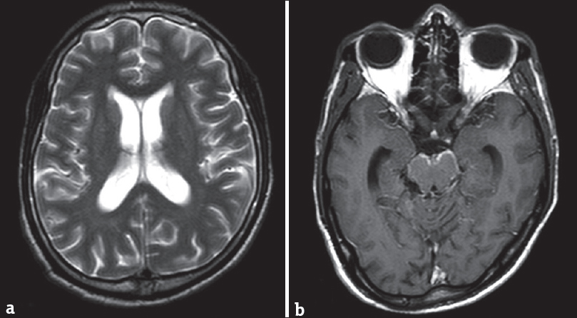 Magnetic resonance imaging scan of a 15-year old girl with tubercular meningitis. T2 axial scan (a) shows mild communicating hydrocephalous. Contrast-enhanced T1 axial scan (b) shows enhancing basal meninges (b). The sylvian fissures, basal ganglia, and cerebral parenchyma are normal.