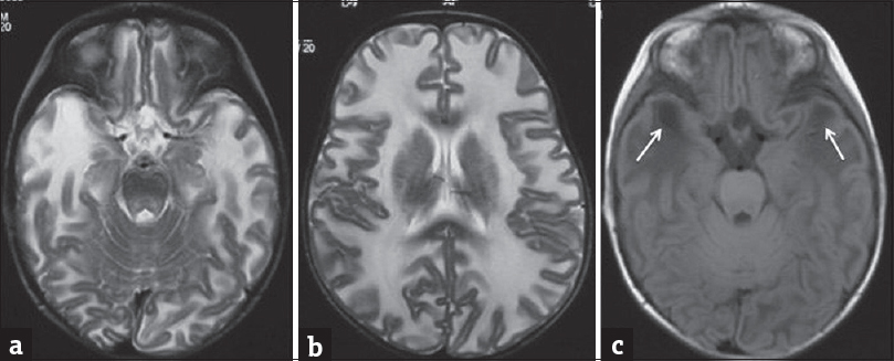 Magnetic resonance imaging scan of a 1-year-old girl with Van der Knaap disease (megaloencephalic leukodystrophy with subcortical cysts). T2-weighted axial images (a and b) show diffuse white matter hyperintensities with swollen appearance of the brain parenchyma with cyst formation at the temporal poles which is better appreciated on the fluid-attenuated inversion recovery image (arrows in c). (Dr. Atin Kumar, Professor, Department of Radiology, AIIMS, New Delhi, India).