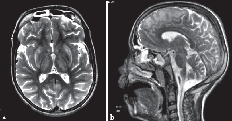 Magnetic resonance imaging scan of a 14-year-old boy with Wilson's disease. T2-weighted axial image (a) shows bilaterally symmetric hyperintensities in basal ganglia and thalami. Sagittal T2-weighted scan (b) shows hyperintense signal in subcortical white matter in the frontal region and in the midbrain.