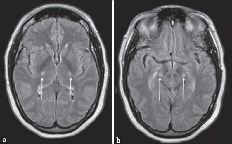 A 57-year-old female with rapid-onset weakness was favored to represent progressive bulbar palsy. (a and b) Symmetric T2 hyperintensities involving the posterior limbs of the internal capsules and cerebral peduncles of the midbrain (arrows).