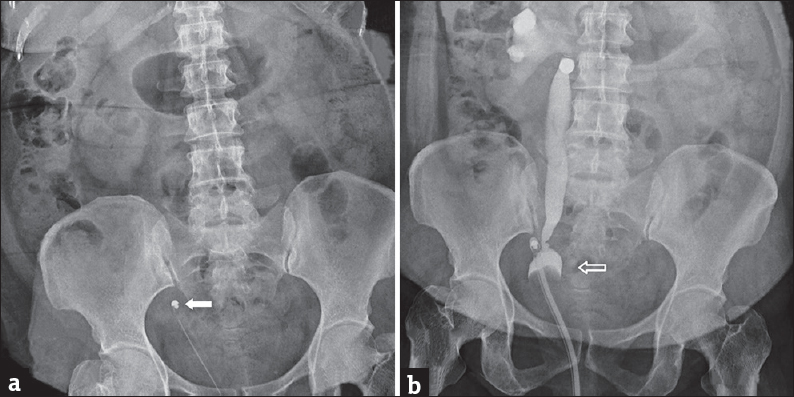 A 47-year-old female underwent transvaginal repair for vesicovaginal fistula acquired after a hysterectomy. (a) Plain X-ray of kidney, ureter, and bladder region shows deviation of the tip of the Foley's catheter toward the right side pelvic wall (white solid arrow). (b) Filling cystogram showing the presence of inflated Foley's catheter (hollow white arrow) inside the lower part of the right ureter with pyelogram and extravasation of the contrast agent around the kidney.