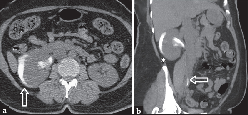 A 47-year-old female underwent transvaginal repair for vesicovaginal fistula acquired after a hysterectomy. (a) Axial section of the plain computed tomography scan of kidney, ureter, and bladder region shows persistent subcapsular curvilinear crescentic contrast extravasation (vertical hollow white arrow) around the right kidney. (b) The coronal section shows right perinephric stranding (asterisk) and intact ureteric continuity (horizontal hollow white arrow).