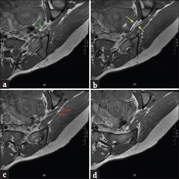 A woman with lower back pain and unilateral radicular symptoms down the posterior right leg. Image (a-d) demonstrates magnetic resonance imaging T1-weighted, axial images of the pelvis, obtained at an oblique angle in respect to the sciatic nerve. (a) At the level of the pelvis, the abnormal sciatic nerve bifurcation begins to come into view (green arrow). (b) At the next oblique level, definitive split morphology of the sciatic nerve is visualized (yellow arrows). (c) Subsequent slice demonstrates the aberrant sciatic slip coursing through the split piriformis bellies (red arrows). (d) Final sequential image redemonstrates the split piriformis morphology (P) with re-joining of the two nerve segments (S).