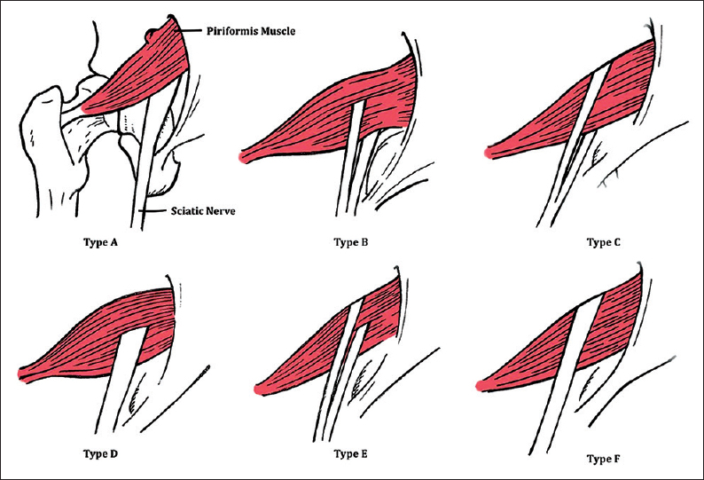 Six anatomic variations of the Beaton and Anson's classification system are demonstrated in this artistic rendition (posterior view). Illustrations are ordered from most common to least common, respectively, with the Type A being the most classic anatomical structure. Type B classification is the uncommon form that we find in our patient.