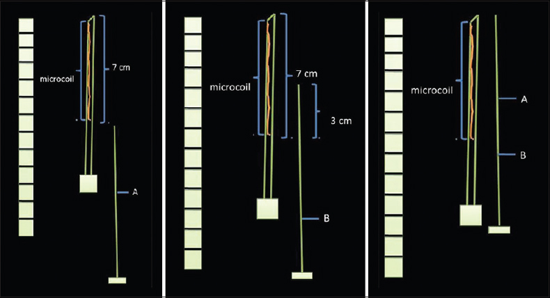 Diagrammatic scheme of predeployment measurement: After loading the 7-cm microcoil into 10-cm 21G Chiba needle by microcoil pusher, two marks were put by a sterile surgical marker pen on the needle stylet. Mark A: The length enough to push the microcoil to the tip of the needle. Mark B: The length enough to eject 30 mm of the microcoil.