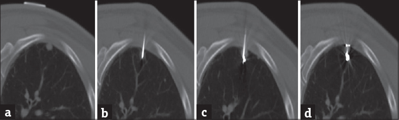 (a) Preprocedural computed tomography with skin localization showing pulmonary nodule. (b) A loaded Chiba needle passed through the pulmonary nodule. (c) The microcoil pushed out and tightly coiled deep to the nodule. (d) The Chiba needle was removed and the proximal microcoil end coiled on the visceral pleural surface.