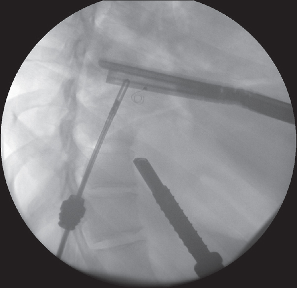 Fluoroscopic image during the video-assisted thoracoscopic lung resection, showing the microcoil within the lung parenchyma. A thoracoscopic port, grasping instrument, and linear stapling devices are noted.