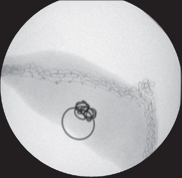 Surgically resected wedge of the lung containing the microcoil.