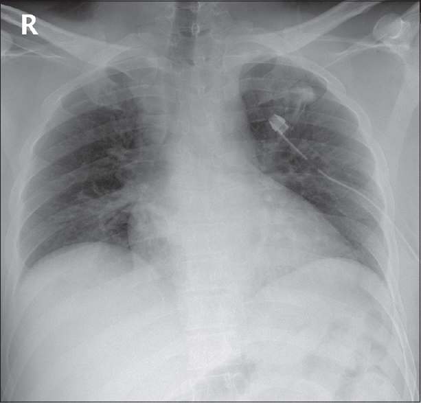 Postoperative chest image showing left-sided chest tube.