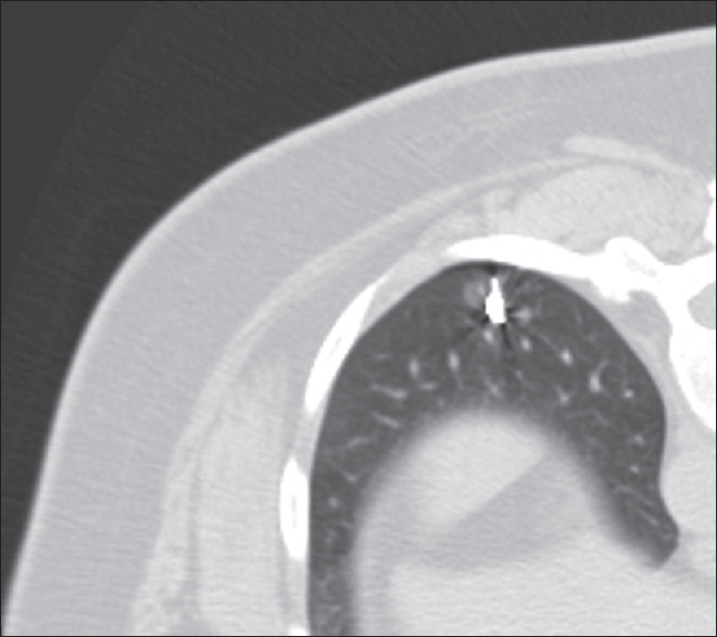 Microcoil placed just adjacent to the pulmonary nodule.