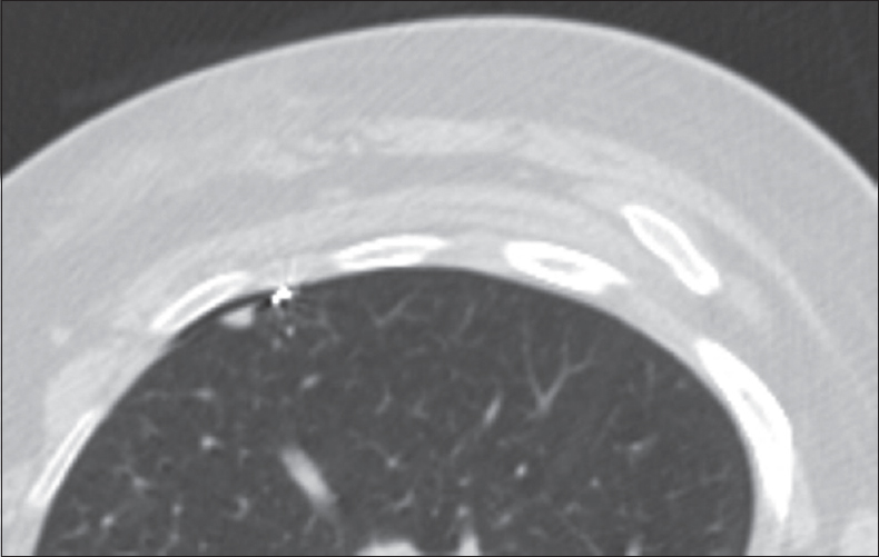 Microcoil placed about 1 cm beside the pulmonary nodule.