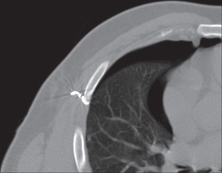 Microcoil misplaced completely within the chest wall. Moderate amount of pneumothorax is noted.