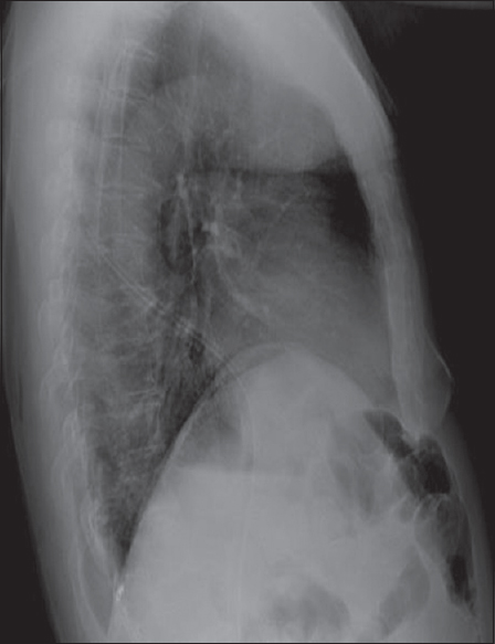 Lateral chest X-ray showing the microcoil fallen into the pleural space at the posterior costophrenic angle.