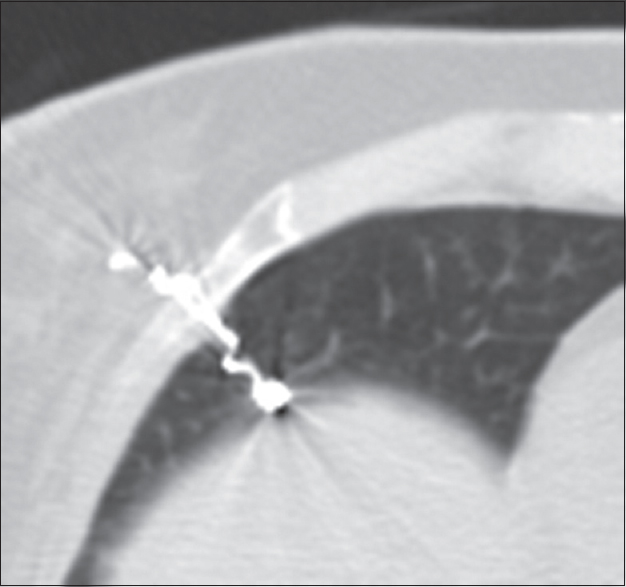 Proximal microcoil end misplaced into the chest wall.