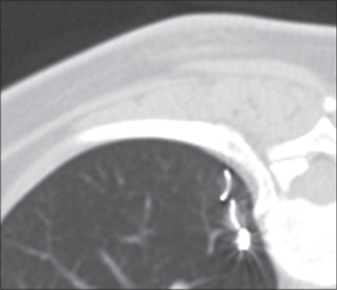 Microcoil misplaced completely within the lung parenchyma.