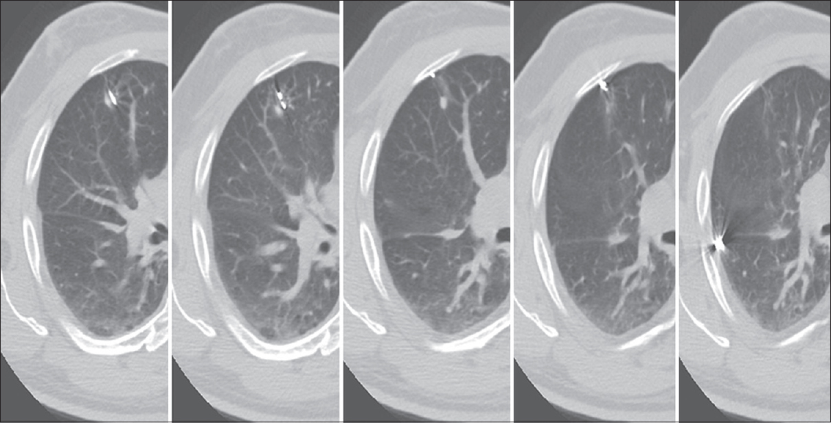 Chiba needle tip pushed the pulmonary nodule. After deploying the microcoil and withdrawing the needle, it retracted into the pleural surface and fell in the pleural cavity laterally.