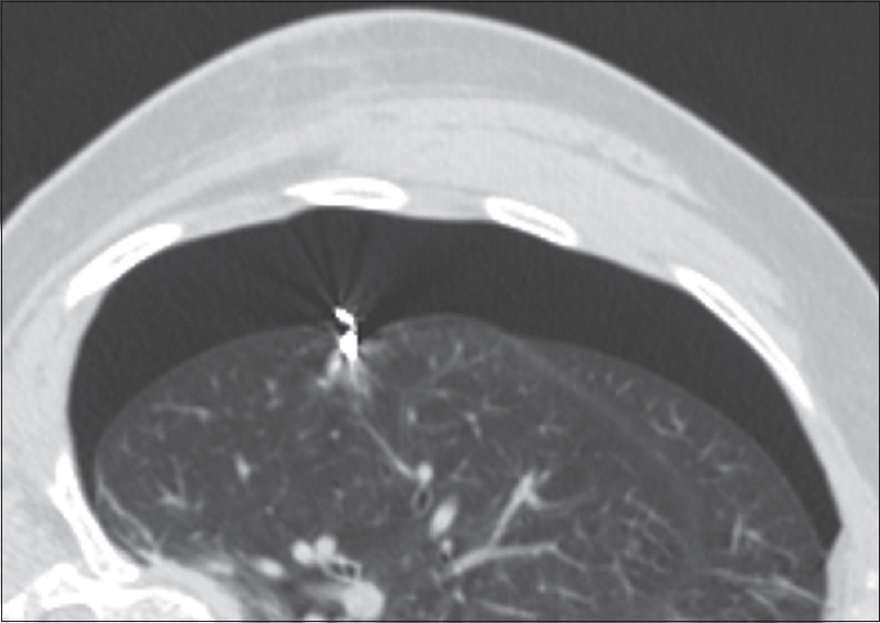 Postlocalization computed tomography image demonstrates moderate amount of pneumothorax.