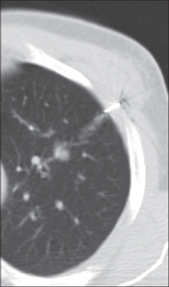 Postlocalization computed tomography image demonstrates mild parenchymal lung hemorrhage in the tract of microcoil localization needle.