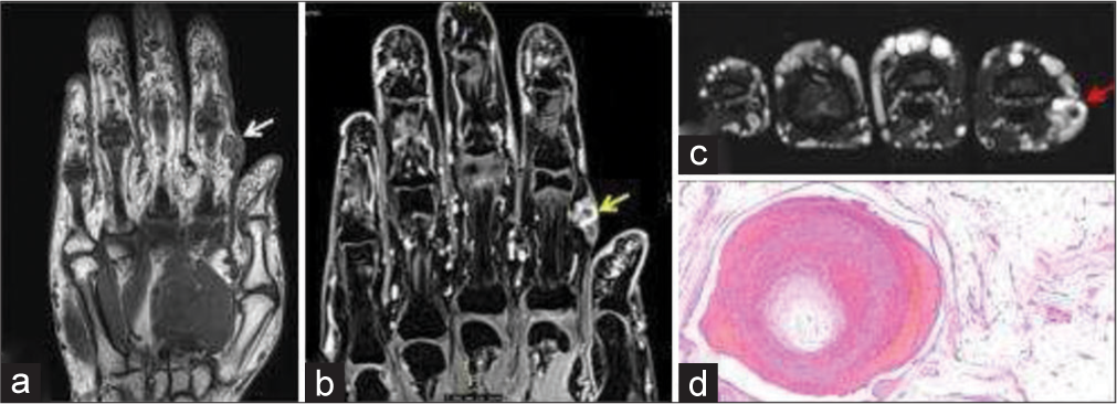 35-year-old woman with non-involuting congenital hemangioma who presented with painless swelling of index finger. (a) Non-contrast T1-weighted coronal magnetic resonance (MR) image shows a nodular hypointense lesion in subcutaneous and intramuscular plane of index finger (white arrow). (b) Fat saturated T1-weighted post-contrast MR image shows contrast enhancement (yellow arrow). (c) Axial T2-weighted image shows T2 flow void within the soft tissue indicating vascular etiology (red arrow). (d) Histopathology section showing lobules of mature adipocytes containing dilated thrombosed blood vessels with adjacent ragged blood vessels.