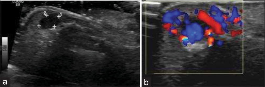 5-year-old boy with soft tissue arteriovenous (AV) malformation of hand who presented with slowly growing swelling of thumb. (a) Gray scale ultrasound image of the tuft of thumb shows a well-defined hypoechoic lesion (measured by calipers), which was misinterpreted as a well-defined cystic lesion. (b) Subsequent Doppler imaging of the lesion demonstrates significant color flow suggestive of AV malformation.